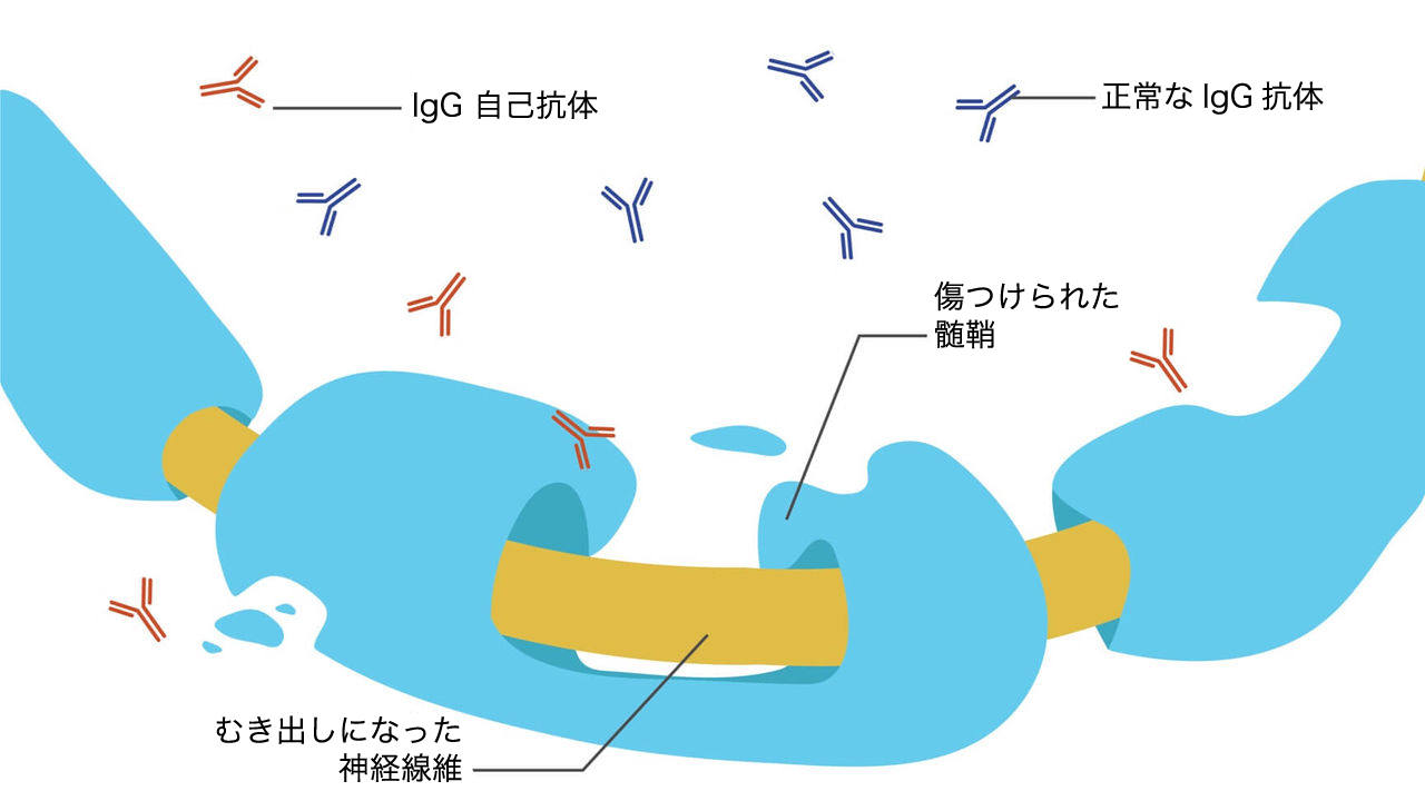 CIDP患者さんの神経細胞の髄鞘（ずいしょう）が傷つけられる原因